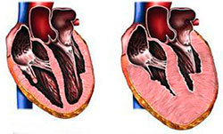 kardiomiopatia